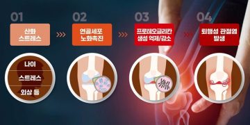건강 정보- 관절염 막으려면 ‘관절스프링’ 프로테오글리칸으로 꼭꼭 채워라!